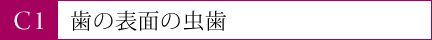 歯の表面の虫歯