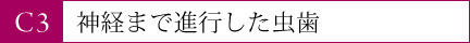 神経まで進行した虫歯