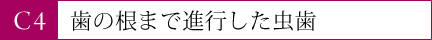 歯の根まで進行した虫歯