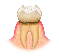 歯肉炎