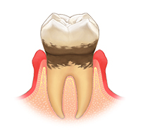 軽度歯周炎