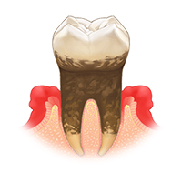 中等度歯周炎